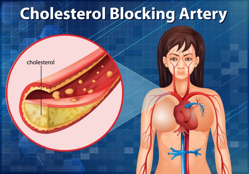 Diagram showing cholesterol blocking artery in human body